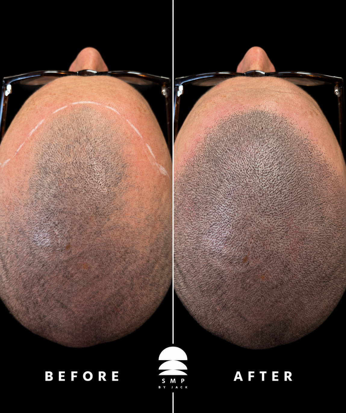 Before and after scalp micropigmentation crown density fill by SMP by Jack, Newport